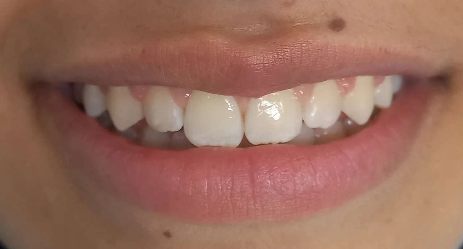Patient A · anterior open bite · 14 months — after at Pure Dental Care