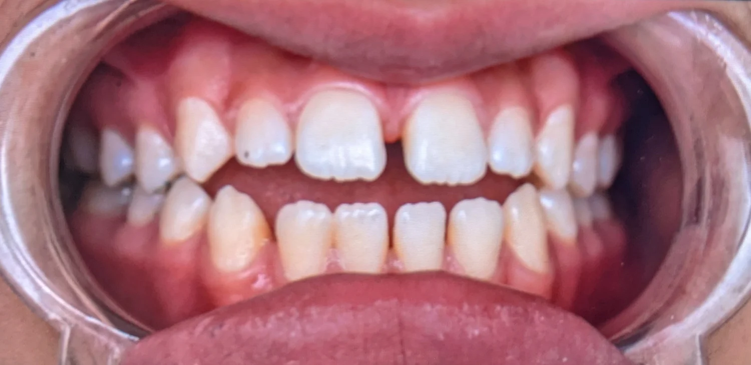 Patient A · anterior open bite · 14 months — before at Pure Dental Care