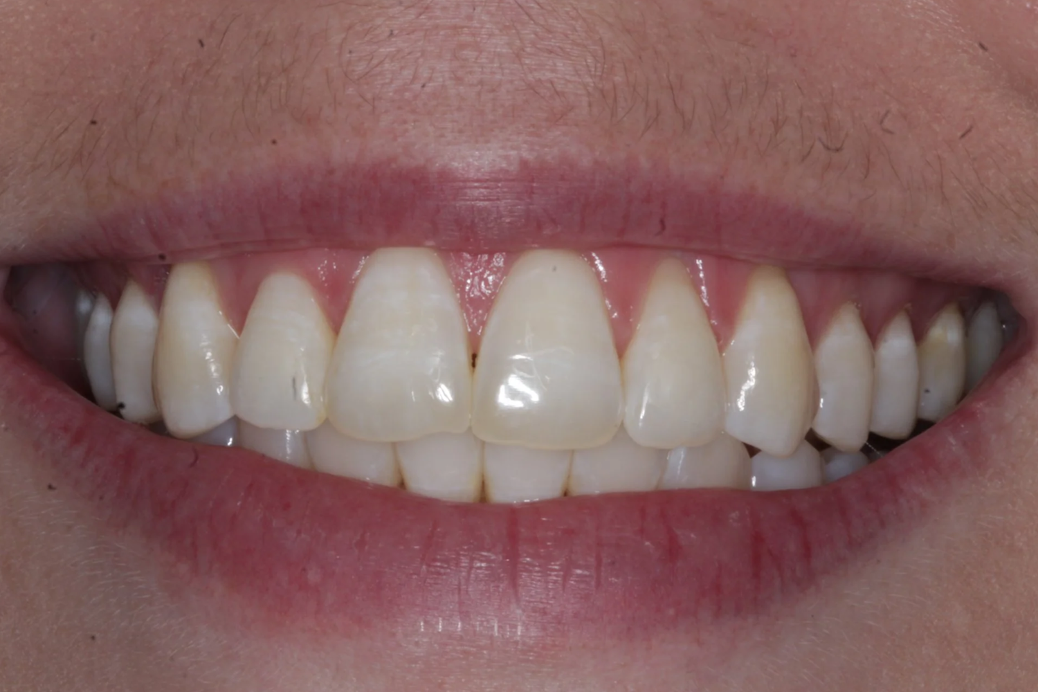 Patient C · anterior open bite · 12 months — after at Pure Dental Care