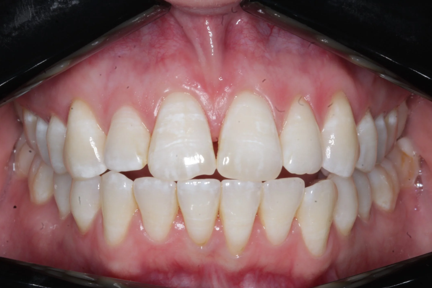 Patient C · anterior open bite · 12 months — before at Pure Dental Care